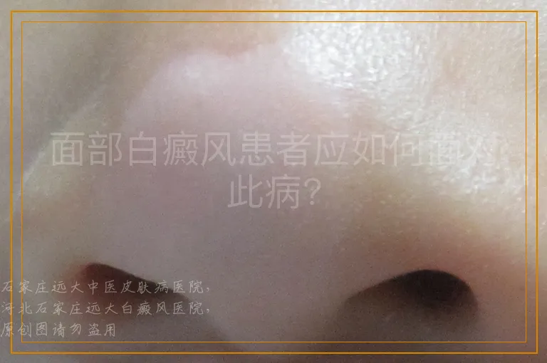 面部白癜风患者应如何面对此病?