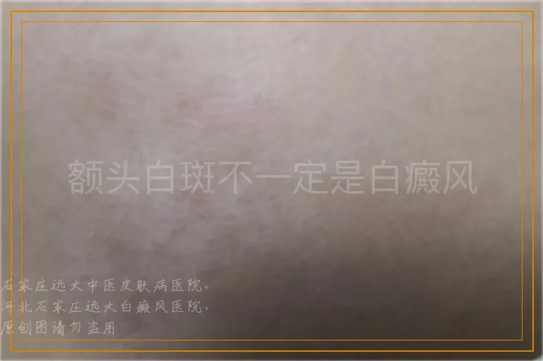 额头白斑不一定是白癜风