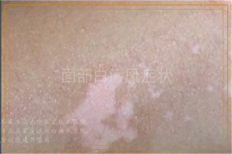 面部白癜风症状