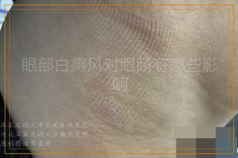 眼部白癜风对眼睛有哪些影响