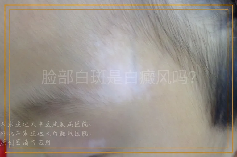 脸部白斑是白癜风吗？