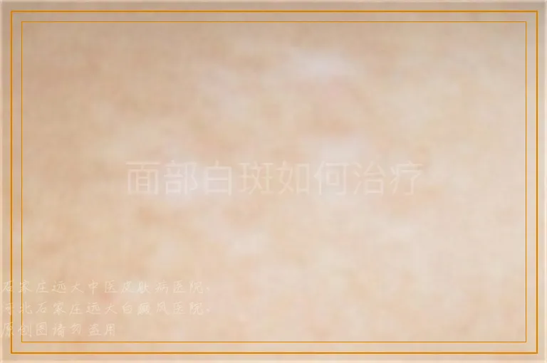面部白斑如何治疗