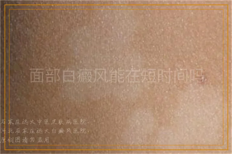 面部白癜风能在短时间吗