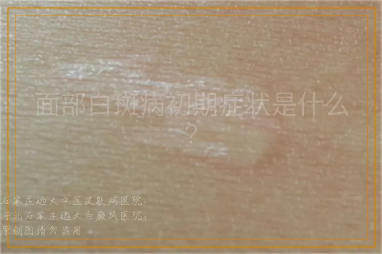 面部白斑病初期症状是什么？
