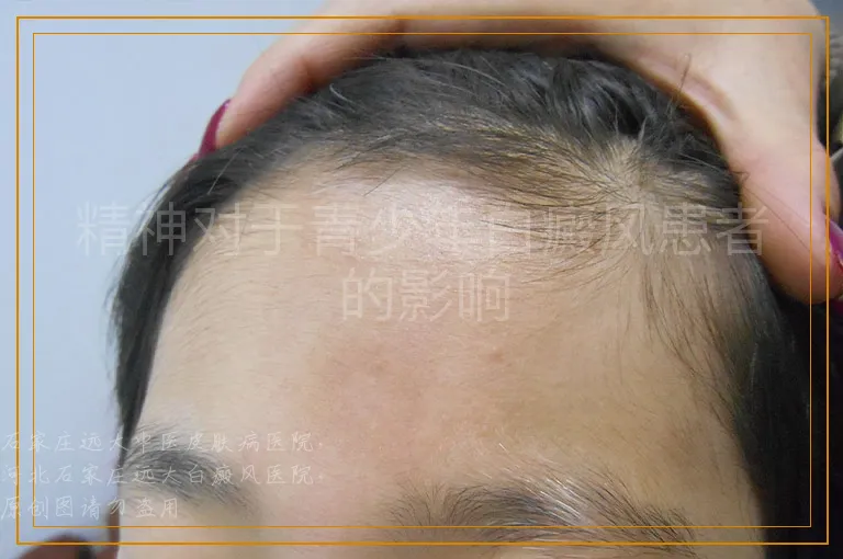 精神对于青少年白癜风患者的影响