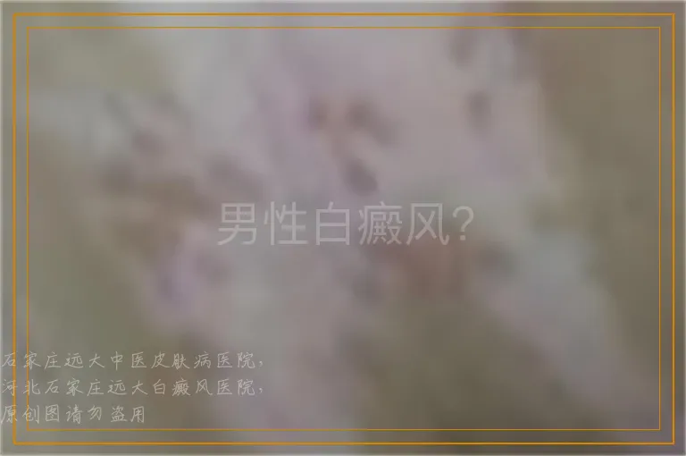 男性白癜风？