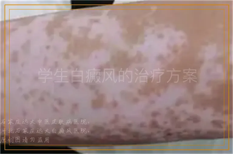 学生白癜风的治疗方案