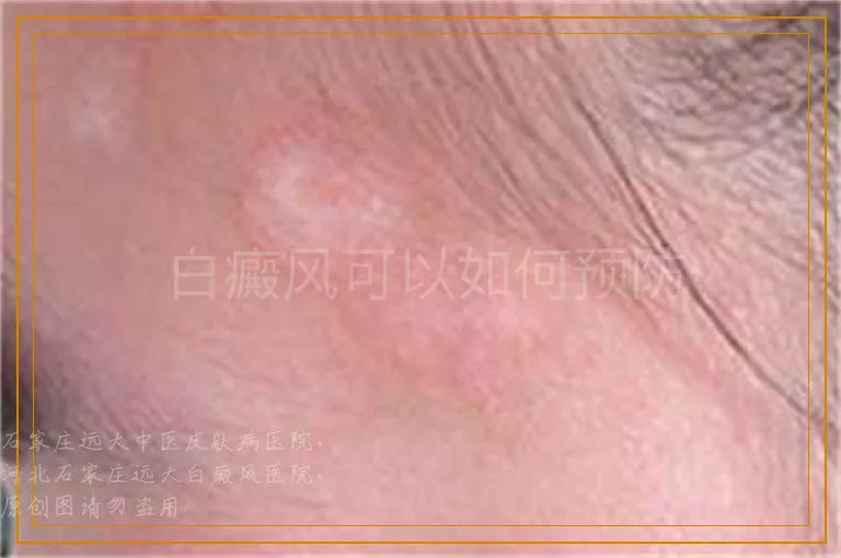 白癜风可以如何预防