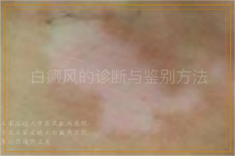 白癜风的诊断与鉴别方法