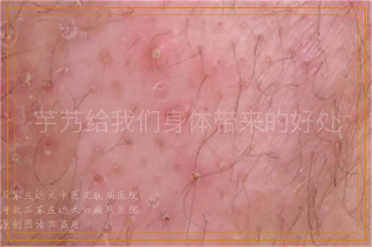 芋艿给我们身体带来的好处