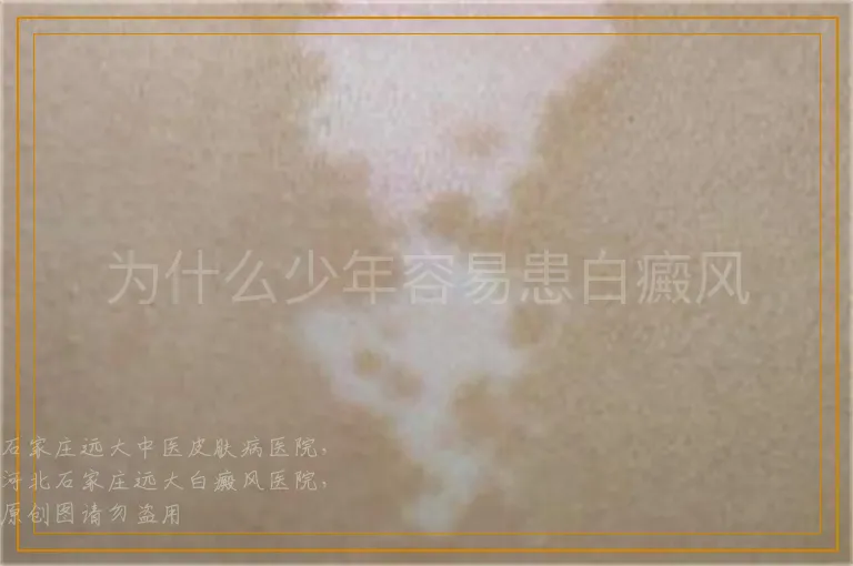 为什么少年容易患白癜风