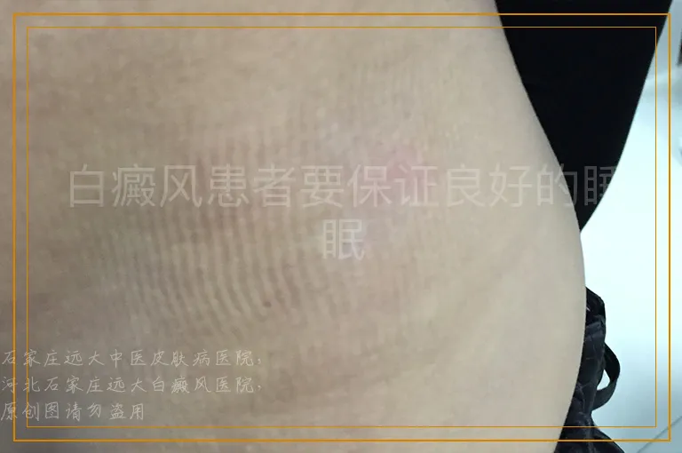 白癜风患者要保证良好的睡眠