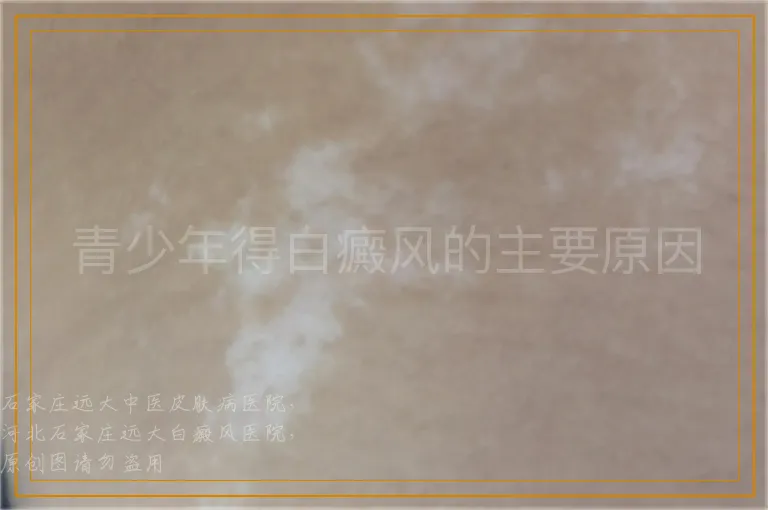 青少年得白癜风的主要原因