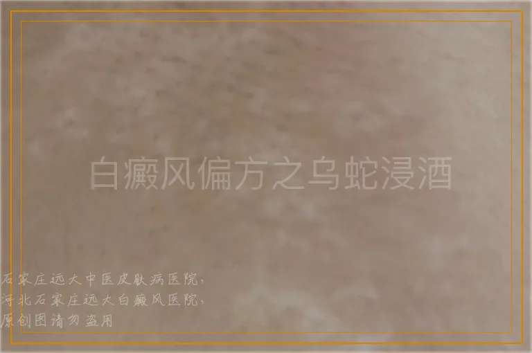 白癜风偏方之乌蛇浸酒