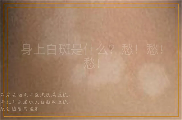 身上白斑是什么？愁！愁！愁！