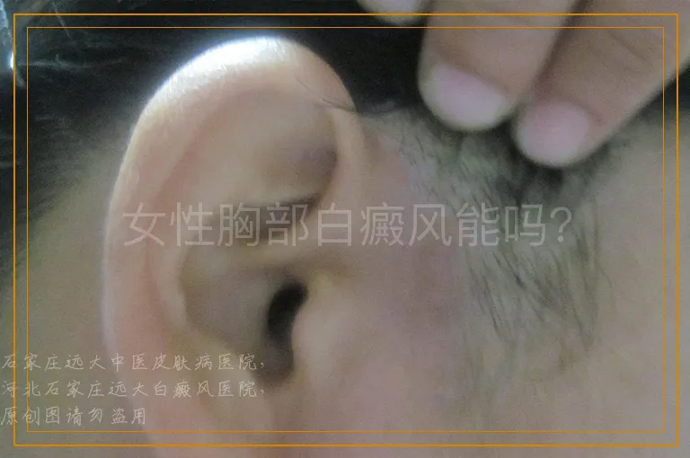女性胸部白癜风能吗？