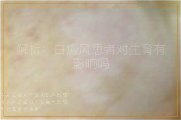 解析：白癜风患者对生育有影响吗