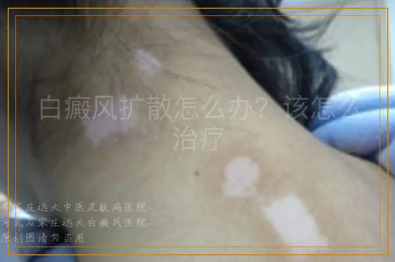 白癜风扩散怎么办？该怎么治疗