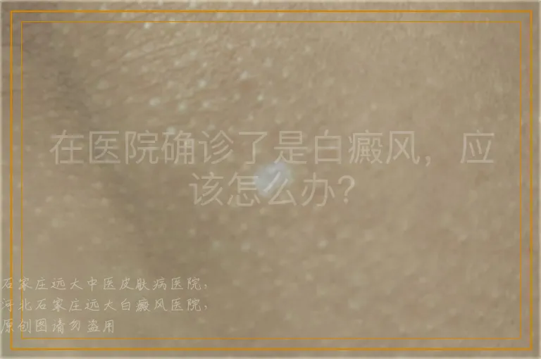 在医院确诊了是白癜风，应该怎么办？