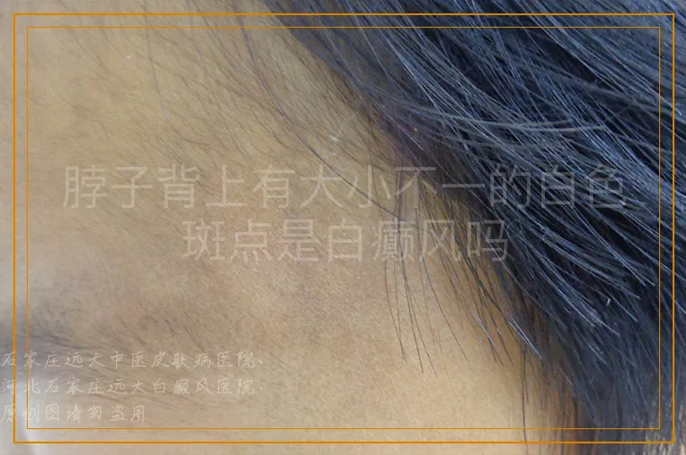 脖子背上有大小不一的白色斑点是白癫风吗