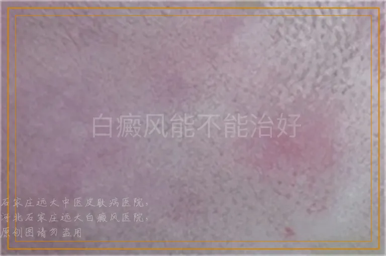白癜风能不能治好