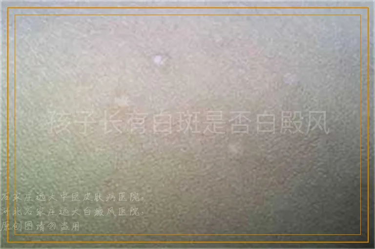 孩子长有白斑是否白殿风