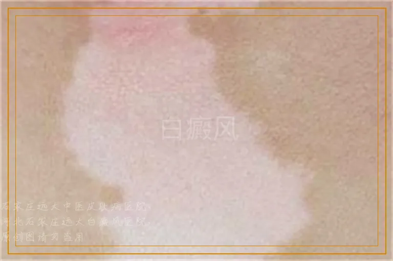 白癜风