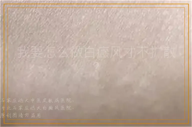 我要怎么做白癜风才不扩散？