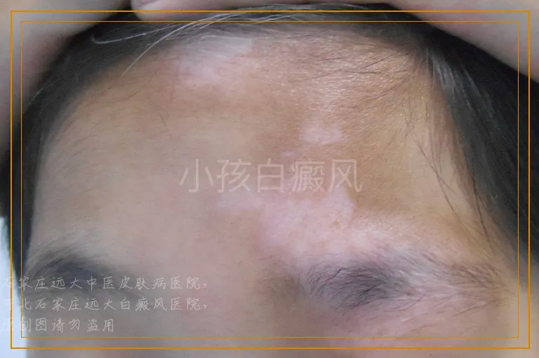 小孩白癜风