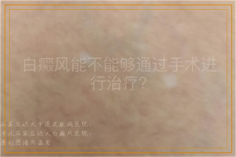 白癜风能不能够通过手术进行治疗？