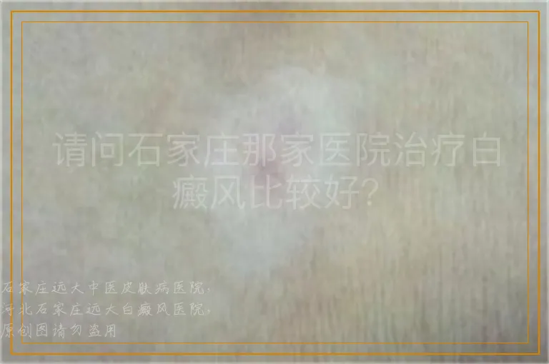 请问石家庄那家医院治疗白癜风比较好？
