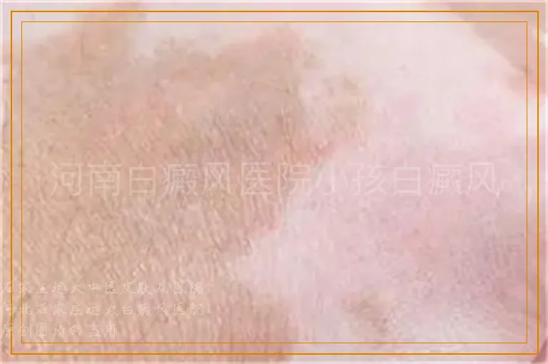 河南白癜风医院小孩白癜风