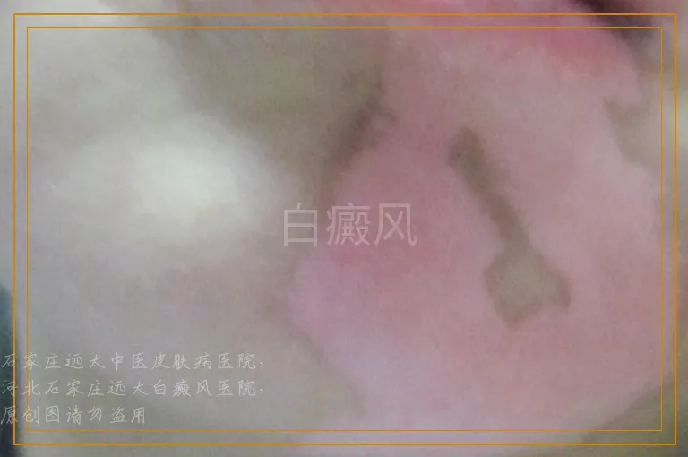 白癜风