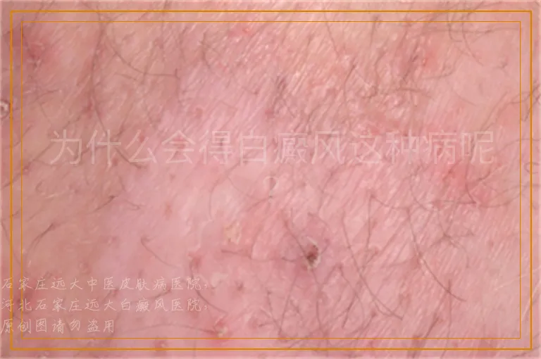 为什么会得白癜风这种病呢？