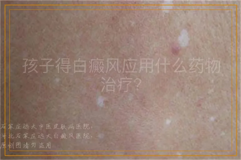 孩子得白癜风应用什么药物治疗？
