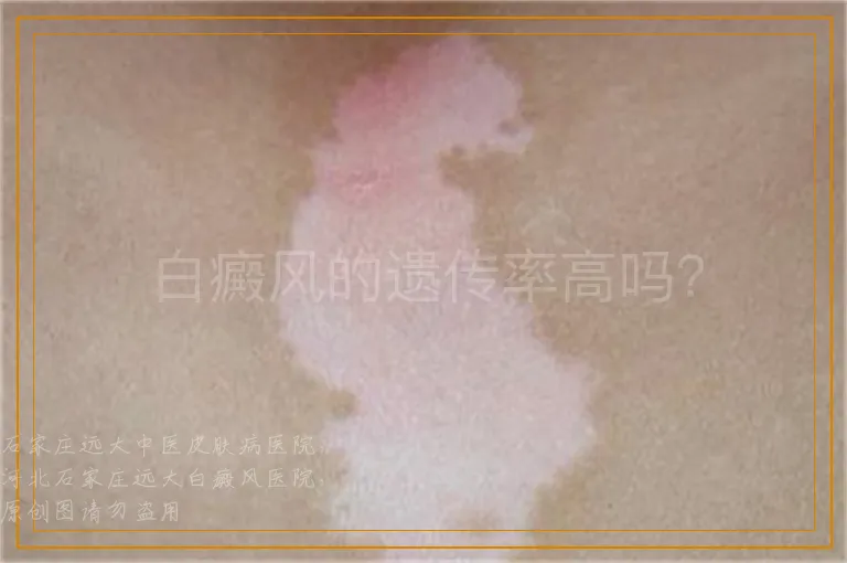 白癜风的遗传率高吗？