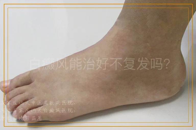 白癜风能治好不复发吗？