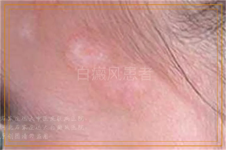 白癜风患者