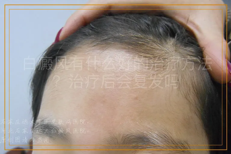 白癜风有什么好的治疗方法？治疗后会复发吗