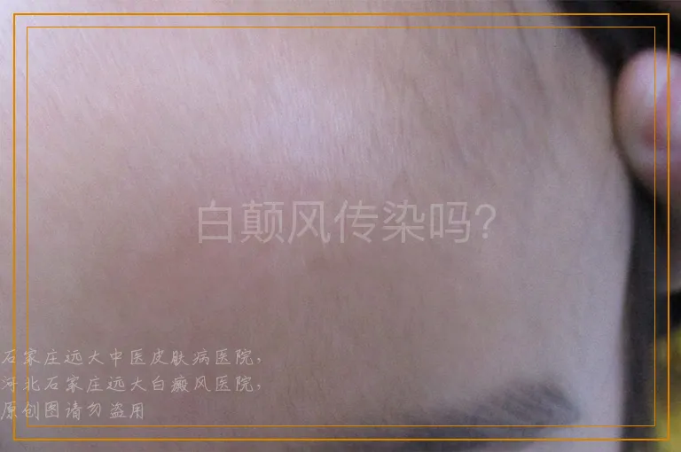 白颠风传染吗？
