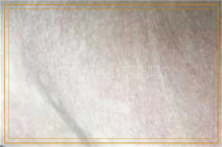 白癜风会传染吗？