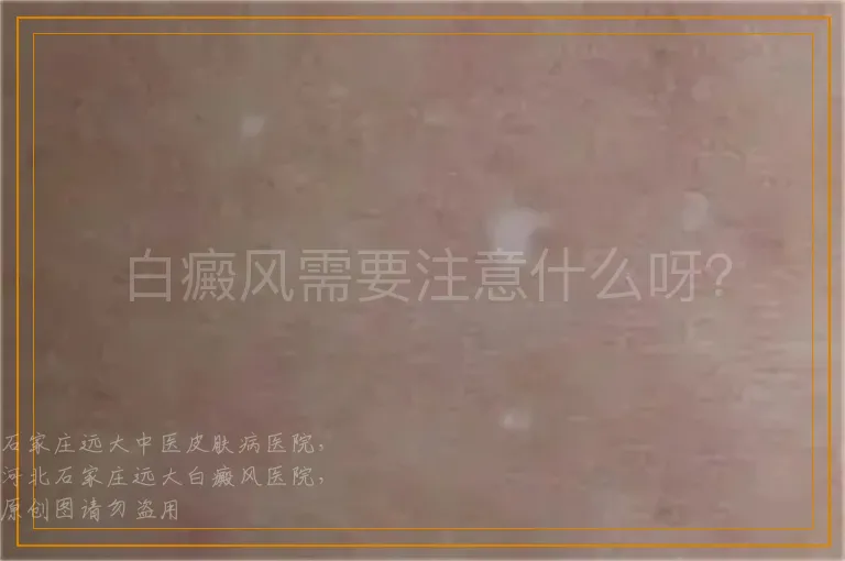 白癜风需要注意什么呀？