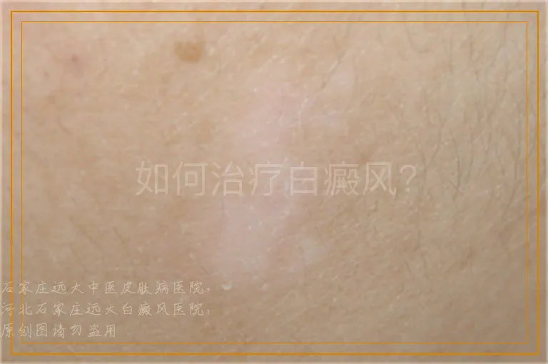 如何治疗白癜风？
