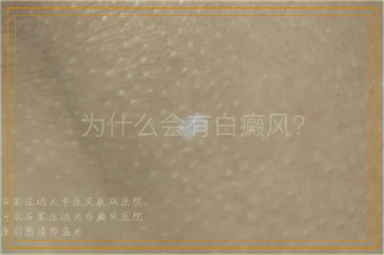 为什么会有白癜风？