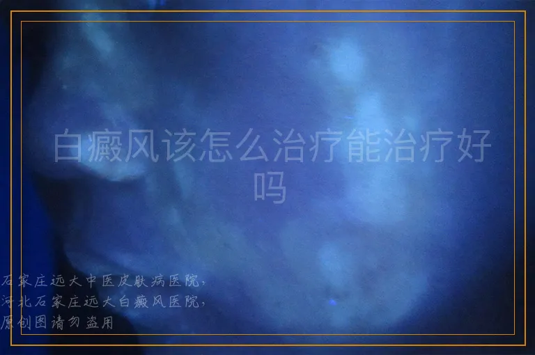 白癜风该怎么治疗能治疗好吗