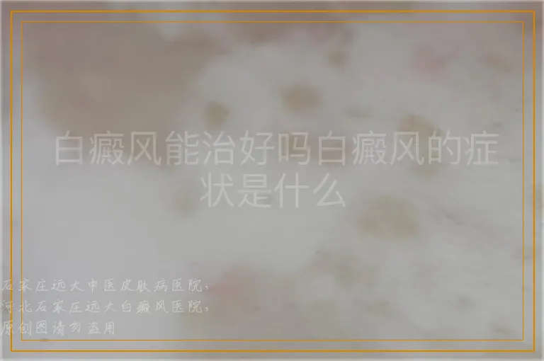 白癜风能治好吗白癜风的症状是什么