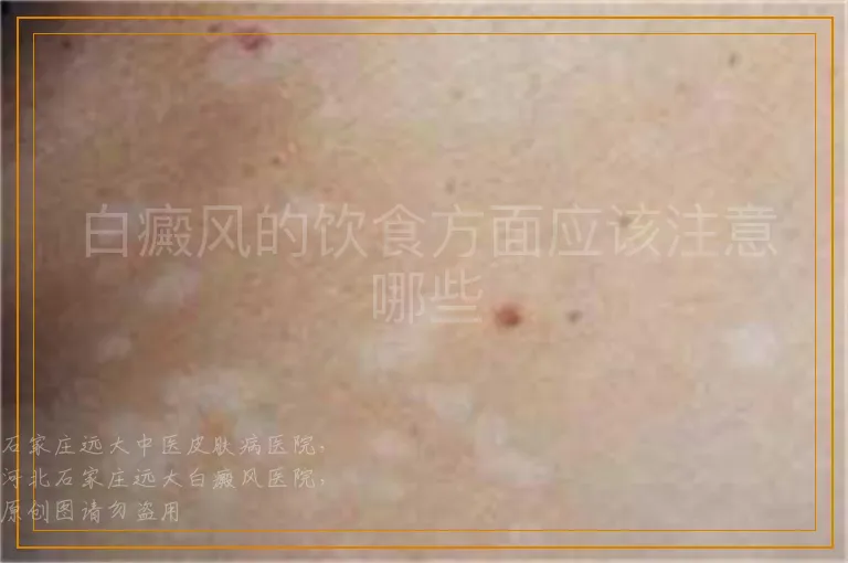 白癜风的饮食方面应该注意哪些