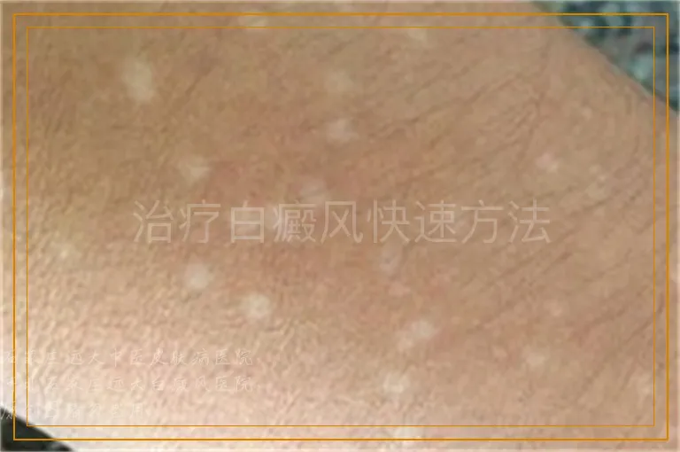 治疗白癜风快速方法