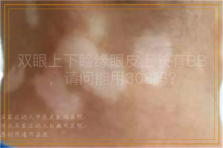 双眼上下睑缘眼皮上长有BB，请问能用308吗？