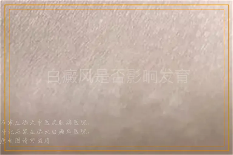 白癜风是否影响发育